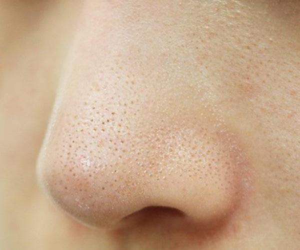cách trị mụn cám