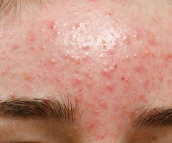 cách nặn mụn ẩn