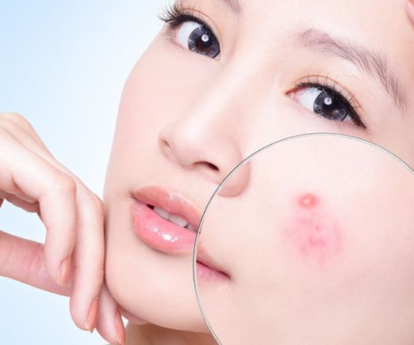 cách nặn mụn bọc