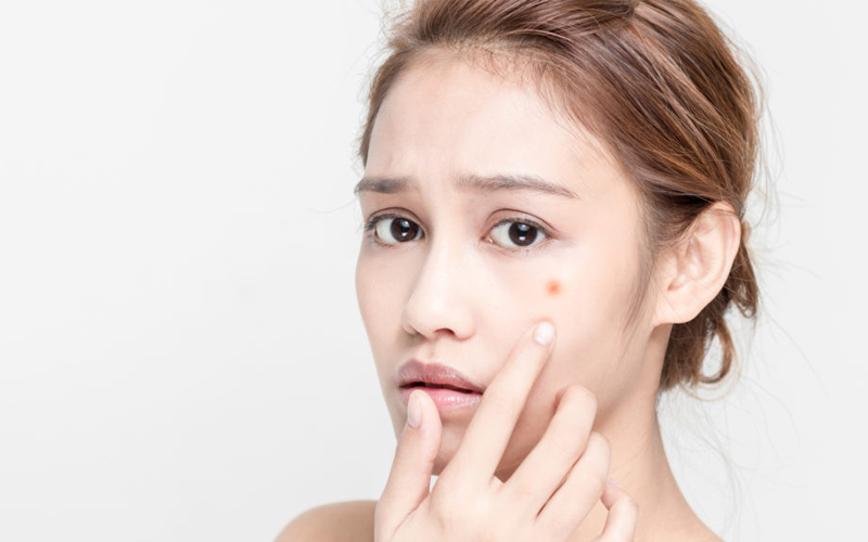 trị viêm da mụn trứng cá